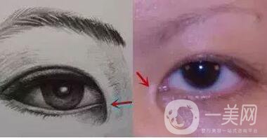 開眼角疼嗎？這幾種情況開眼角*果堪比換頭！