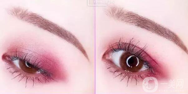 開眼角疼嗎？這幾種情況開眼角*果堪比換頭！