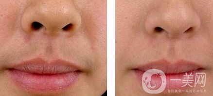 冰點(diǎn)脫唇毛靠譜嗎？