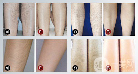 激光脫毛脫了還會(huì)長嗎？