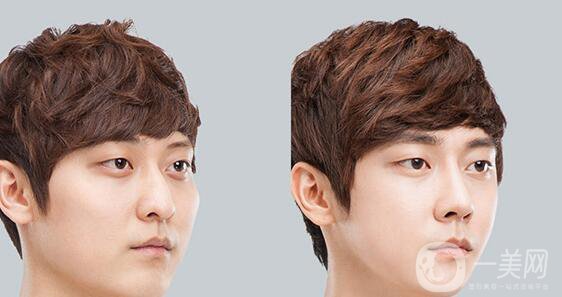 高級面部輪廓手術(shù)有哪些？