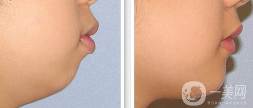 高級面部輪廓手術(shù)有哪些？