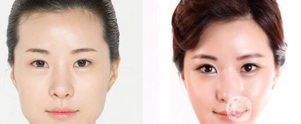 高級面部輪廓手術(shù)有哪些？