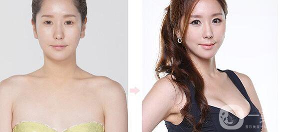 韓國(guó)假體隆胸手術(shù)