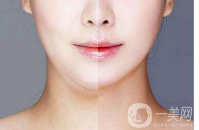 臉部吸脂術(shù)大概多少錢(qián) 臉部吸脂會(huì)反彈嗎？