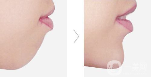 下頜骨后縮怎么矯正？矯正方法有哪些？