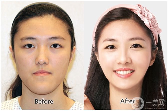 下頜后縮會不會遺傳呢 下頜后縮可以調節(jié)嗎