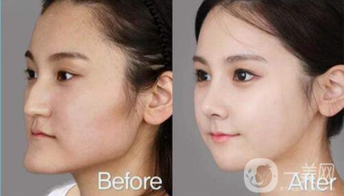 什么是面部不對(duì)稱手術(shù)