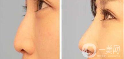 膨體隆鼻多久恢復(fù),膨體隆鼻注意事項