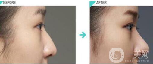 膨體肋骨隆鼻多久恢復(fù),膨體肋骨隆鼻術(shù)后護(hù)理