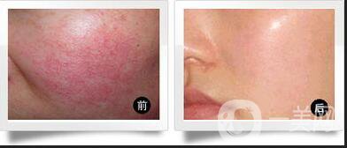 opt彩光嫩膚副作用,opt彩光嫩膚術(shù)后護(hù)理