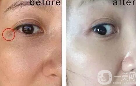 光電美容價(jià)格,光電美容副作用