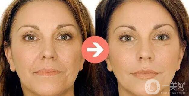 瑞藍(lán)玻尿酸保持多久,瑞藍(lán)玻尿酸詳細(xì)介紹 