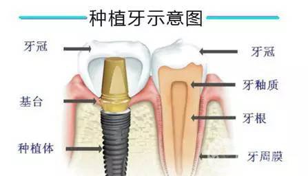 人工種植牙齒價格 手術(shù)費用多少錢？