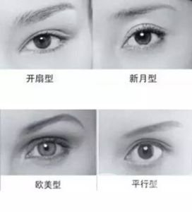 全切雙眼皮多久自然 手術(shù)有年齡限制嗎？