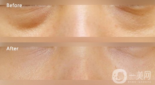 內吸去眼袋多少錢 去眼袋方式有哪些？