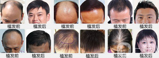 植發(fā)費用多少錢 價格高不高？