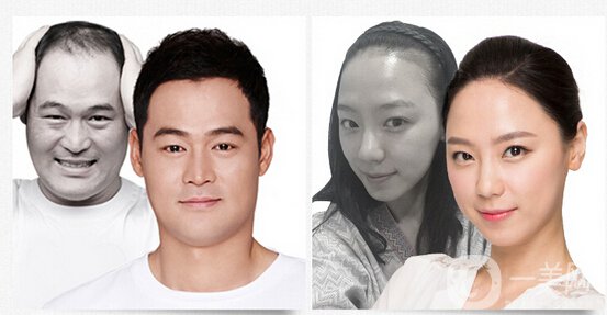 植發(fā)費用一般是多少？植發(fā)前后