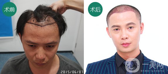 植發(fā)費用一般是多少？植發(fā)前后