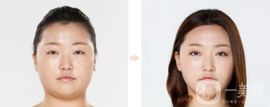 等離子激光溶脂容易反彈嗎