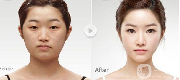 *手術(shù)后幾天恢復(fù) 手術(shù)恢復(fù)過程