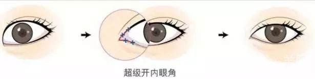 *開(kāi)眼角怎么做的 *開(kāi)眼角多久恢復(fù)