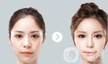 自體肋軟骨隆鼻危害有哪些？隆鼻價(jià)格