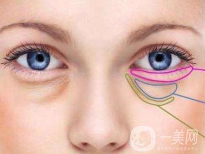 *去眼袋的副作用 會反彈嗎