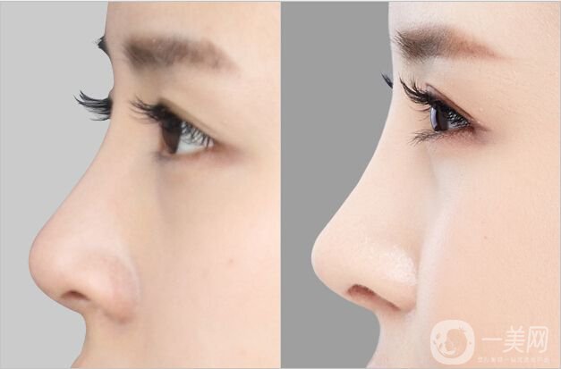 自體肋軟骨隆鼻的價位 