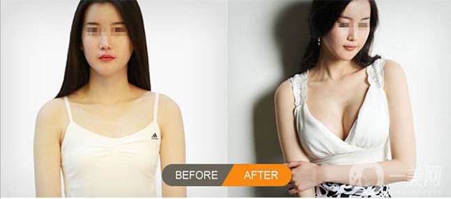 什么是隆胸手術(shù) 乳房植入物類型