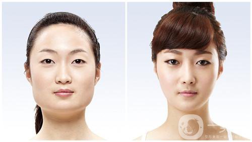 下頜角術(shù)后頭套戴多久合適 