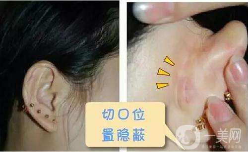 耳軟骨*后遺癥 耳軟骨*手術(shù)費用