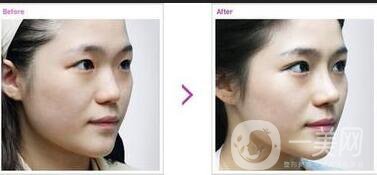 鼻尖整形費(fèi)用,鼻尖整形注意事項(xiàng)