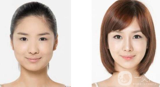 下頜角手術(shù)恢復(fù)期是多久