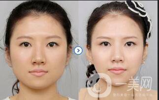 v-line,磨下頜角,區(qū)別在哪里