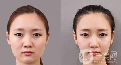 顴骨手術(shù)多久恢復(fù),顴骨手術(shù)注意事項(xiàng)