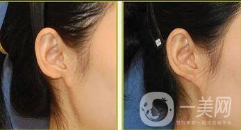 自體脂肪填充耳垂好嗎,自體脂肪填充耳垂多少錢