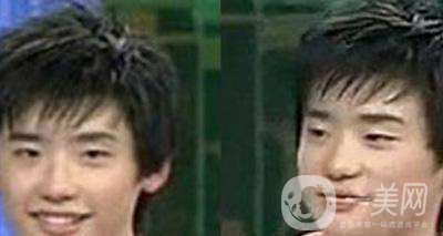 李鐘碩承認(rèn)整容：李鐘碩整容前后照片