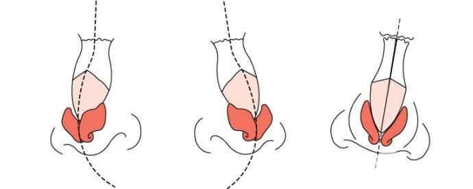 什么是偏鼻矯正手術(shù) 哪些人適合做鼻矯正手術(shù)