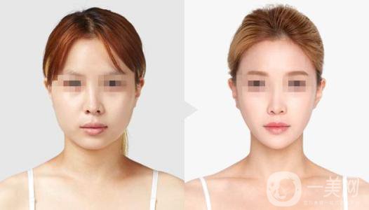 下頜角手術(shù)后多久*果才出來 多久消腫呢