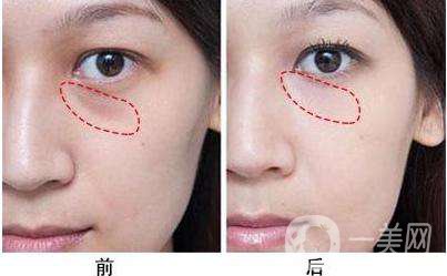 脂肪填充幾天開始吸收？