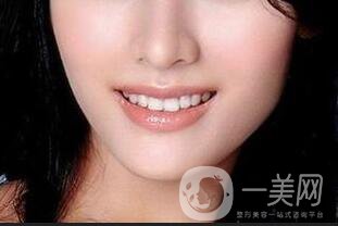 假體做下巴大概多少錢(qián)