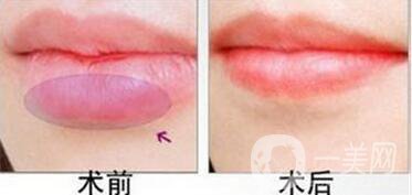 厚嘴唇變薄整形多少錢