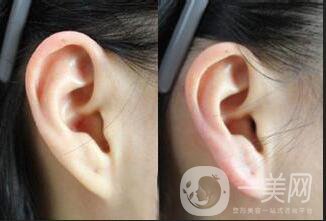 自體脂肪豐耳垂