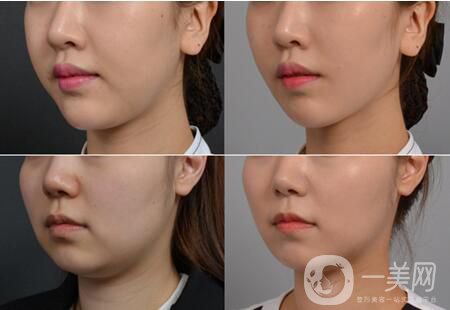 什么是自體脂肪墊下巴 自體脂肪填充的優(yōu)勢