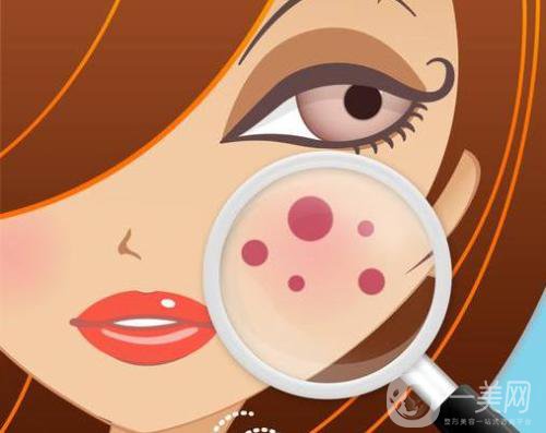 冷凍祛斑幾天結(jié)痂脫落呢