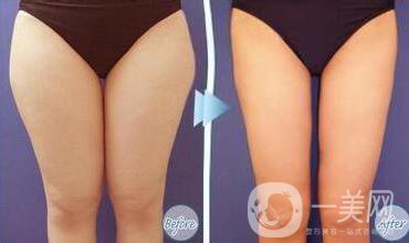 環(huán)形吸脂價(jià)格,360環(huán)形吸脂*果