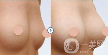 硅膠隆胸怎么樣？硅膠隆胸恢復期多久？