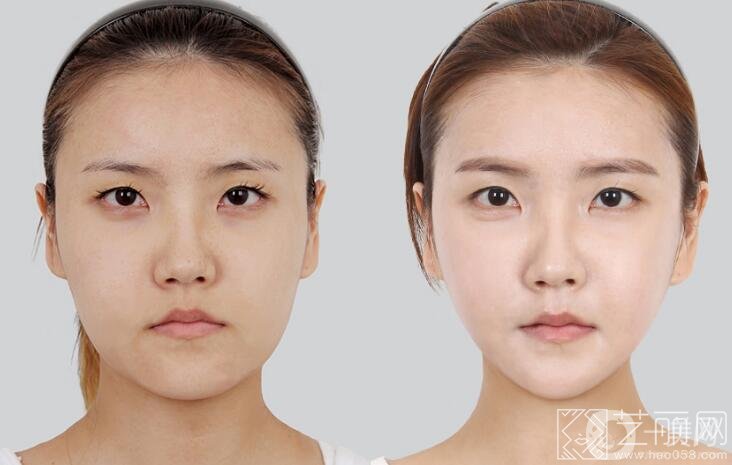 什么是面部提升 面部提升操作方法