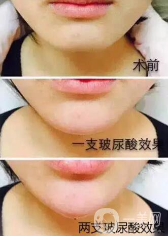 玻尿酸豐下巴需要幾針？兩針玻尿酸下巴*果圖